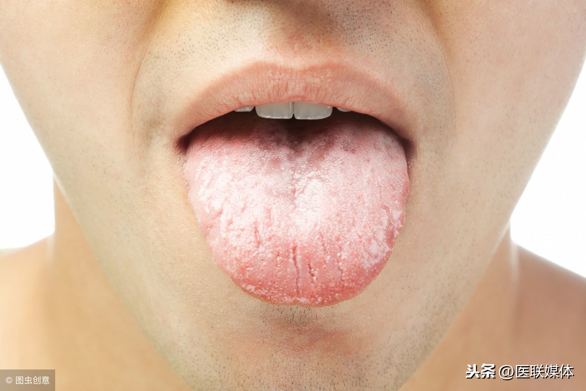 舌乳头炎你了解多少？再也不要害怕了！！！ - 知乎