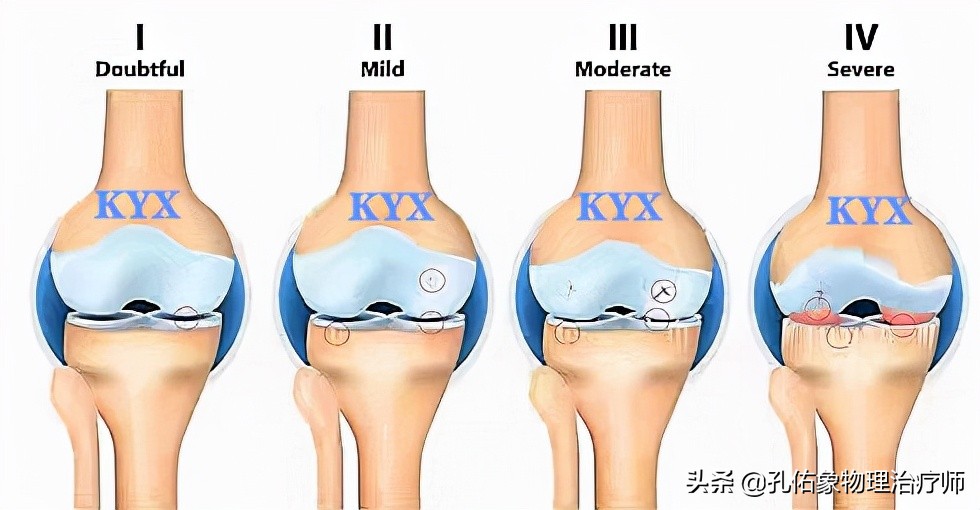 膝关节为什么疼痛？能治好吗？该如何应对呢？给您详细讲清楚