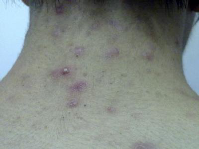 脖子上面长痘痘的原因是什么？
