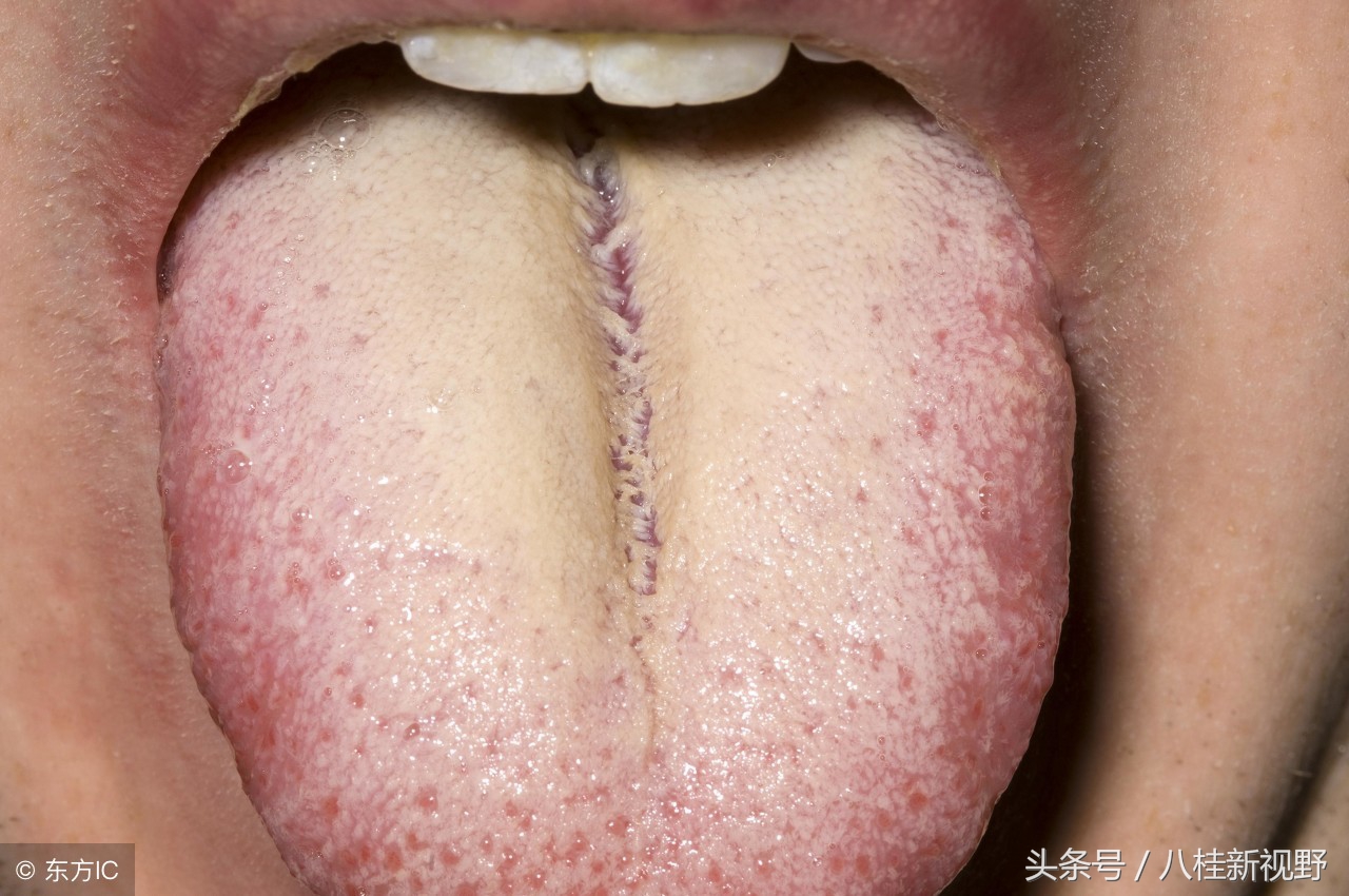舌苔发黄是什么原因？中医认为，黄苔表明病邪深入