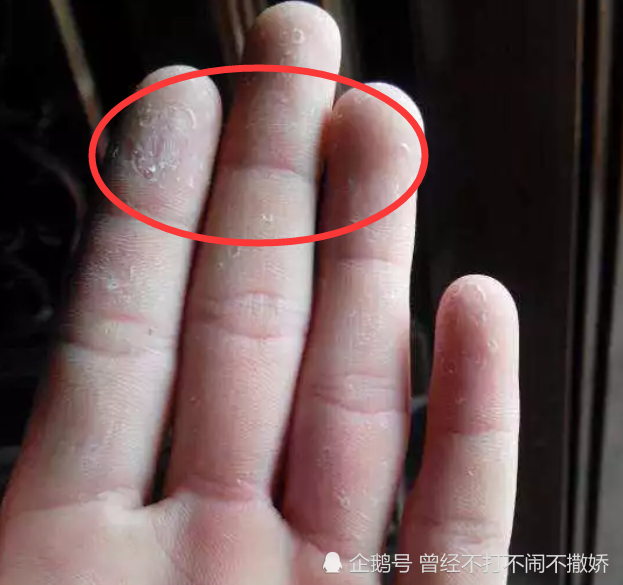 手指“脱皮”是什么造成的？八成是身体发出的求救信号，最好别大意
