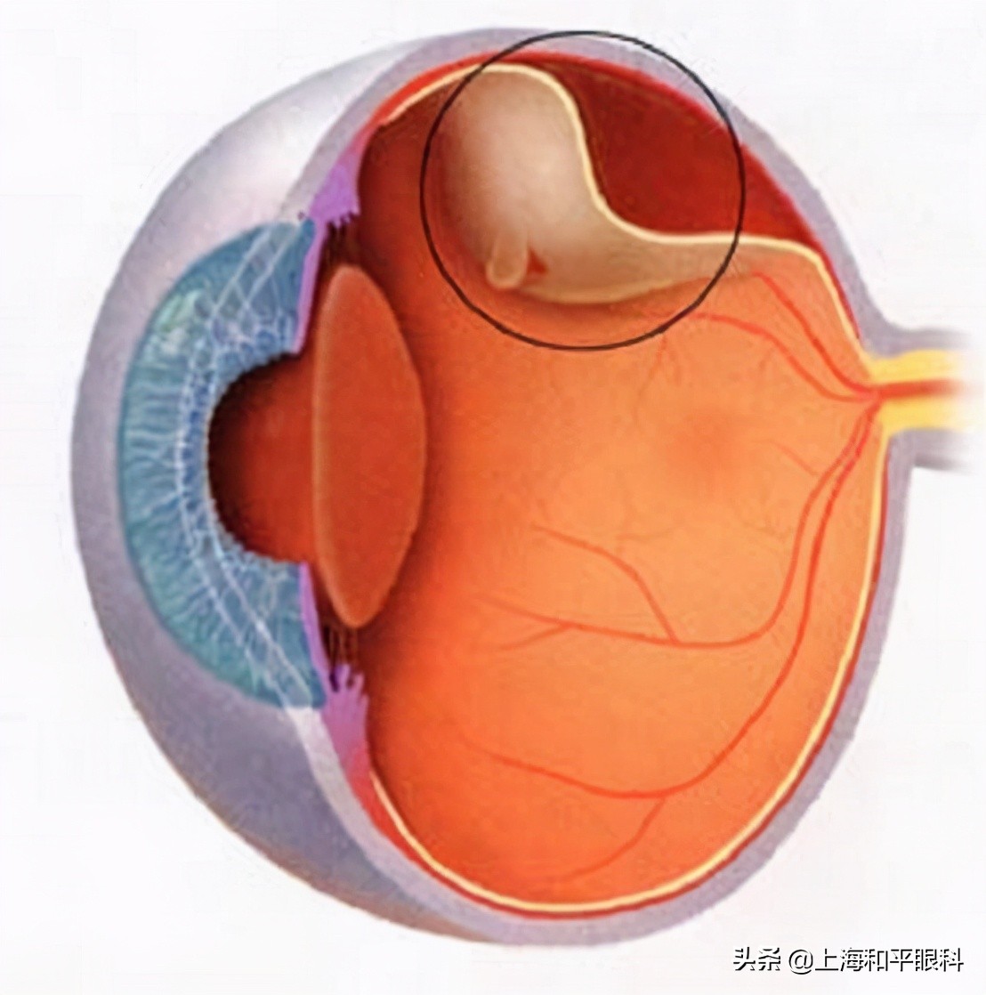 视网膜变性疾病——9、周边视网膜变性 - 知乎