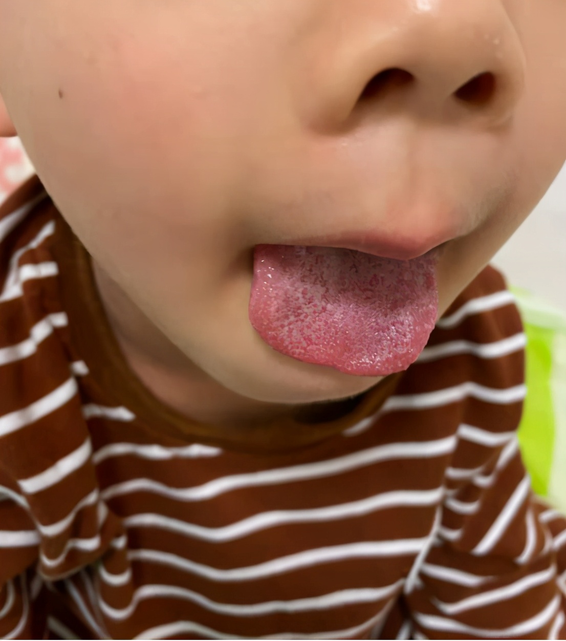 赤ちゃんの口・歯の病気 地図状舌の症状とケア【医師監修】｜たまひよ