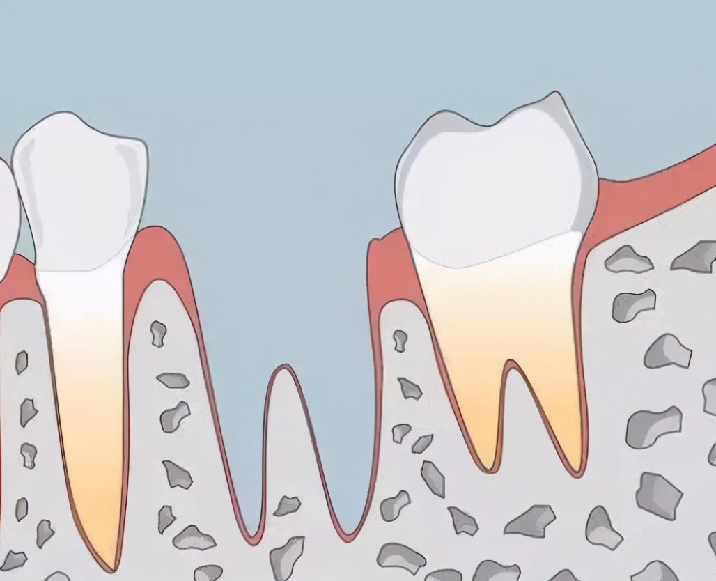 拔牙牙洞恢复过程图解分析（失去牙齿后，伤口要愈合多久？） | 说明书网