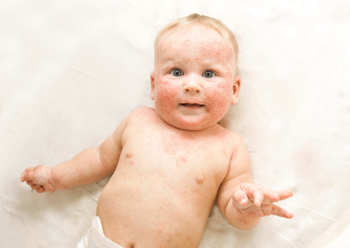 宝宝湿疹怎么办？最详细的湿疹的护理攻略 - 知乎