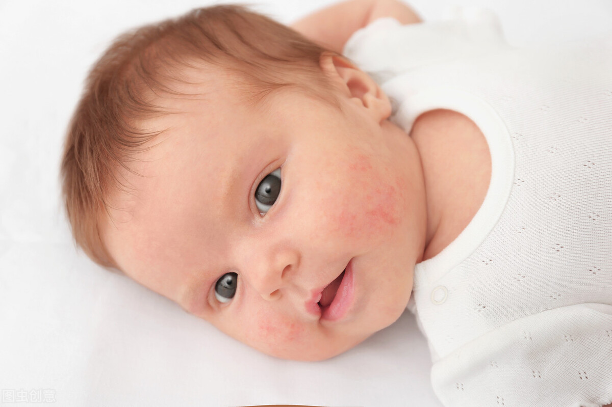 婴儿热疹和湿疹症状图片对照及护理（皮肤课堂｜婴幼儿湿疹与痱子分不清？小心越护理越严重） | 说明书网