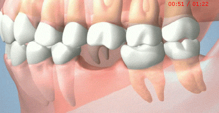 掉一个牙为什么补三个（为什么我缺了一颗牙，医生却让镶我三颗？）