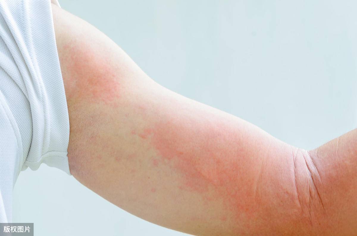 湿疹有哪些典型症状_手部湿疹_邻医网