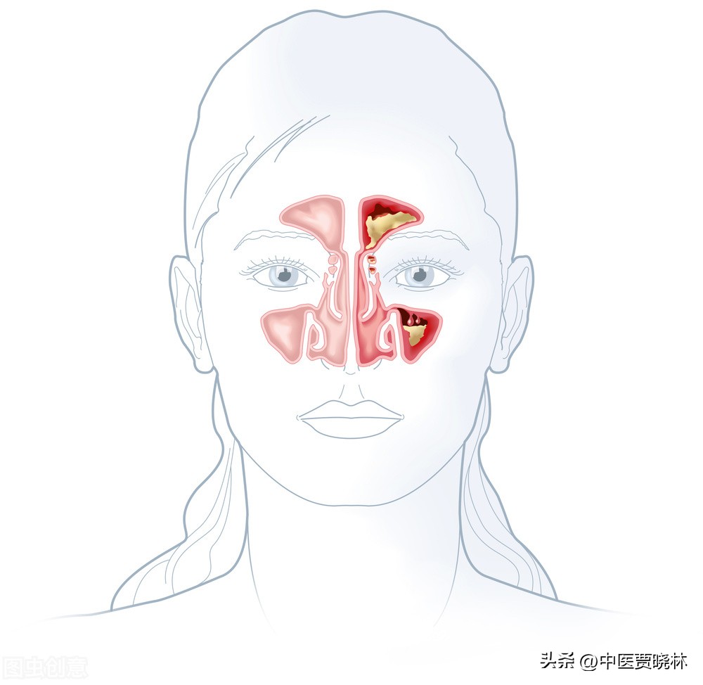 鼻炎鼻塞怎么治疗最有效（鼻炎，鼻塞反复不好，多是阳气不通，送你一个方子，通阳、通鼻腔）