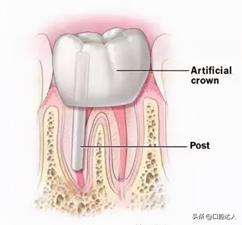 牙根发炎怎么快速消炎（牙齿发炎，吃点消炎药就可以了吗？）