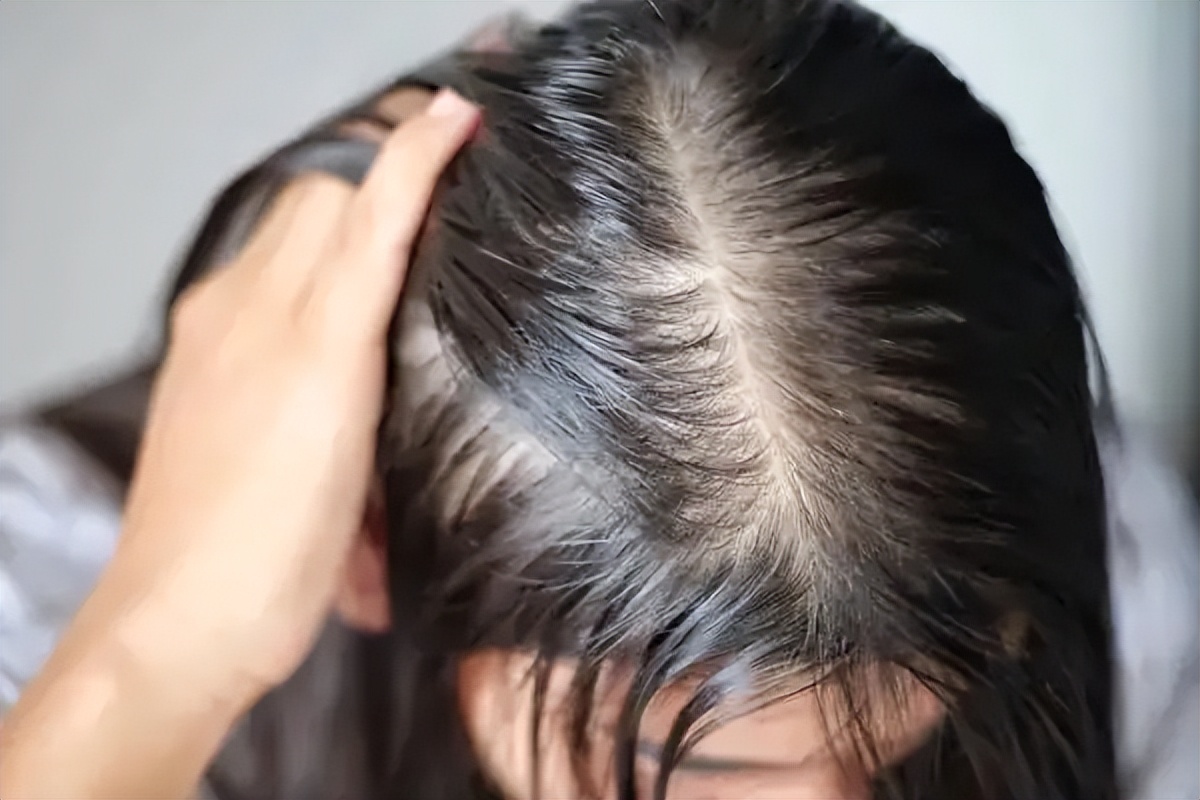 脂溢性脱发有哪些表现特征？ - 知乎