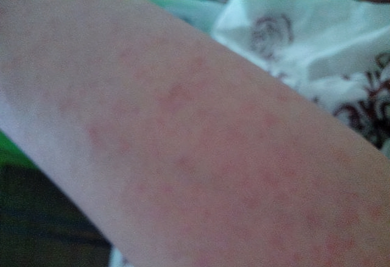 大腿内侧起一片红疹子，刚起的时候很痒，好了之后还起_皮肤科_邻医网