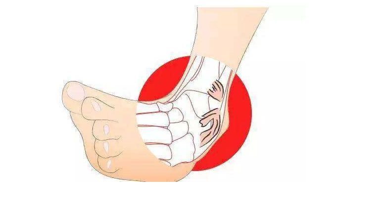扭伤脚怎么办最有效（扭脚后要活血化瘀，应该进行热敷吗？）