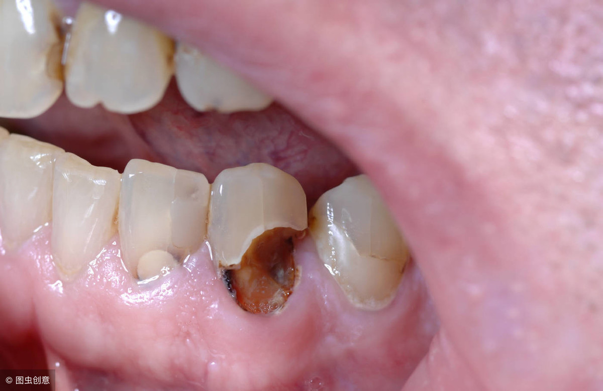 牙根外露、牙齦萎縮 竟是刷牙惹的禍！牙醫教5技巧慢慢刷！ | 中天新聞網