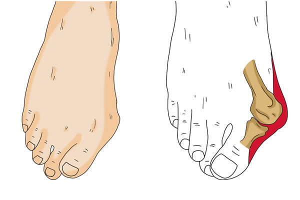 脚跟疼是怎么回事用什么药（脚跟疼痛是怎么回事？缺钙了？不一定，或许和这2种疾病有关）