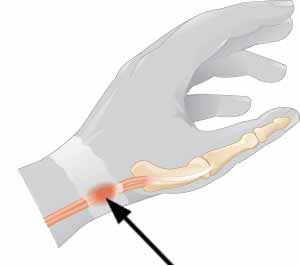 什么是腱鞘炎腱鞘是指哪些部位（腱鞘炎好发于哪里？哪里是腱鞘？什么是腱鞘炎）-第1张图片-冰筹网