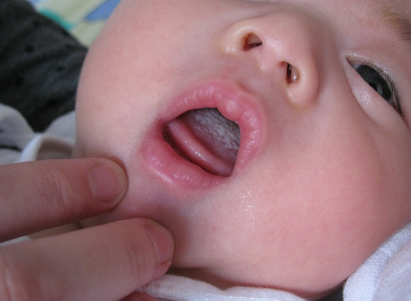 婴儿口腔溃疡怎么办（吃一口饭疼一下，孩子口腔溃疡怎么办？4个妙招帮你轻松过关）-第2张图片-冰筹网
