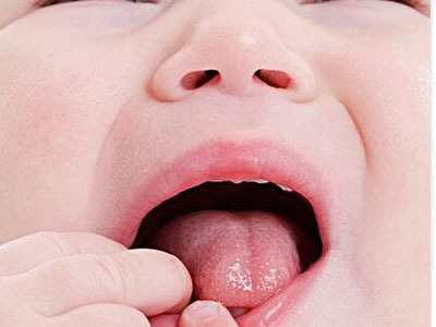 婴儿口腔溃疡怎么办（吃一口饭疼一下，孩子口腔溃疡怎么办？4个妙招帮你轻松过关）-第4张图片-冰筹网