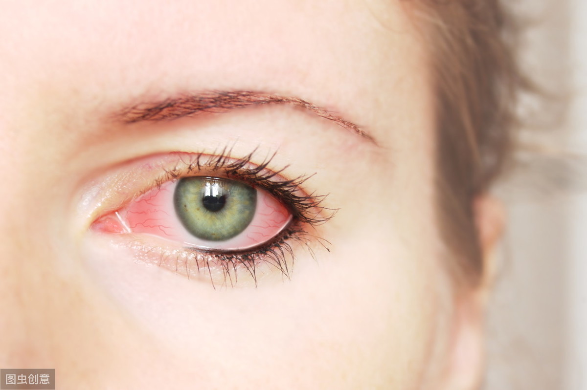 Subconjunctival Hemorrhage: Odd Bloody Stains in the Eyes - The DailyMoss