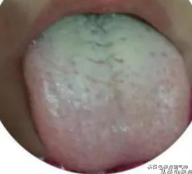 舌头白是怎么回事（“舌苔厚”是病吗？舌头白腻说明了什么？听听医生怎么认为的）