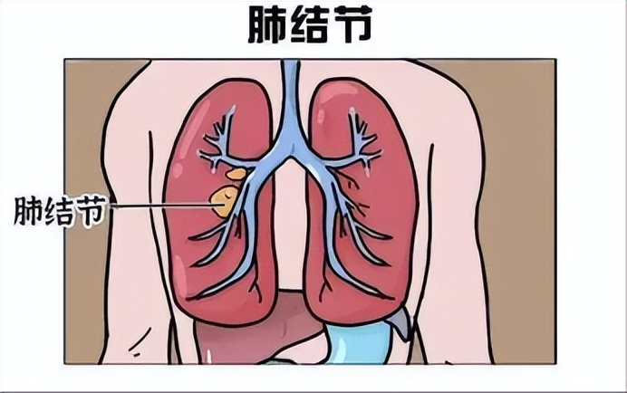 肺上有结节是怎么回事（肺结节是怎么回事？出现5个症状，可要警惕了）