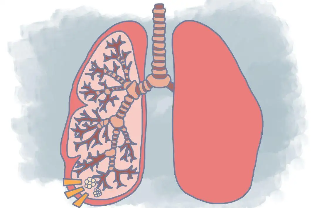 肺上有结节是怎么回事（肺结节是怎么回事？出现5个症状，可要警惕了）