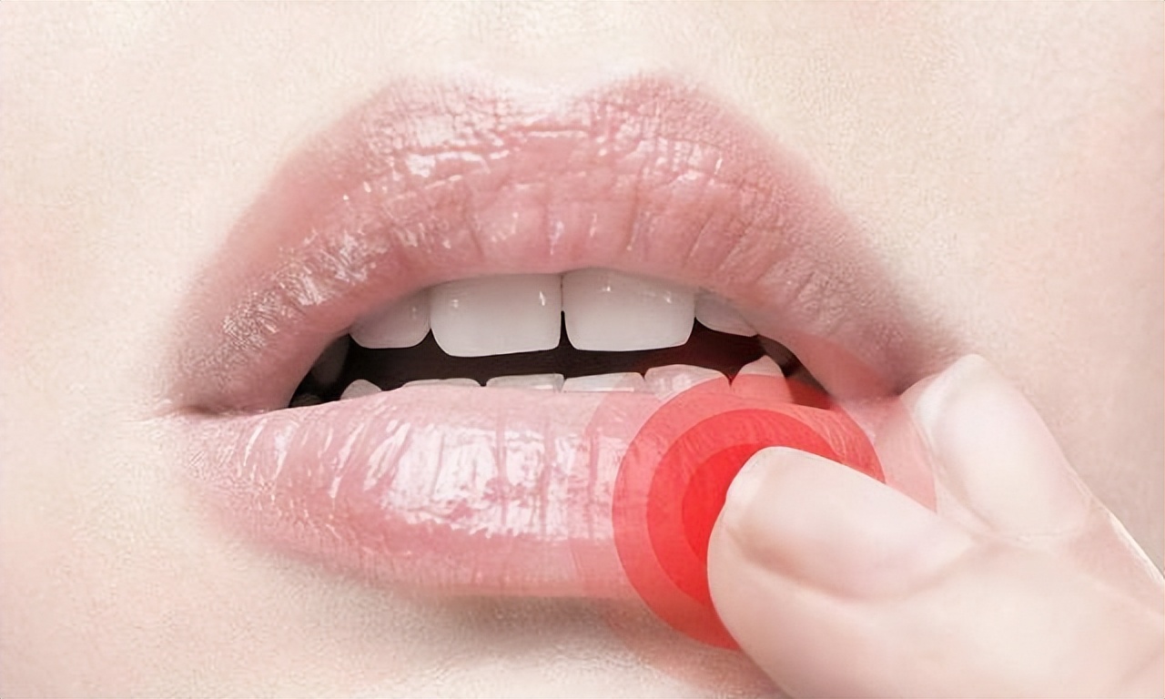 冬季嘴唇发干、起皮不是缺水 可能是一种病|嘴唇|缺水|冬季|润唇膏|唇部|水分|干裂|-健康界