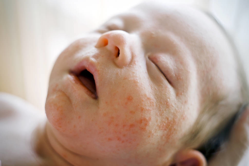 婴儿脸上湿疹怎么办小妙招（重要的事情说三遍！婴儿湿疹有妙招）